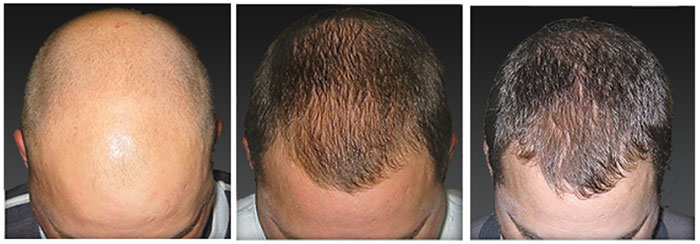 laser-hair-loss-treatment-01