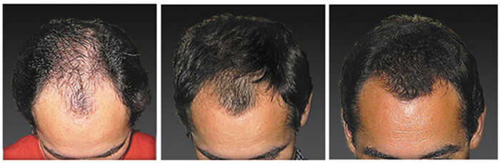 laser-hair-loss-treatment-02