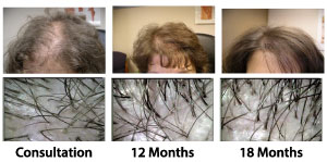 female-hair-loss-treatment